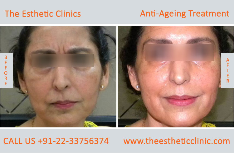 Anti Aging Treatment for Face Wrinkles before after photos in mumbai india (1 (9)